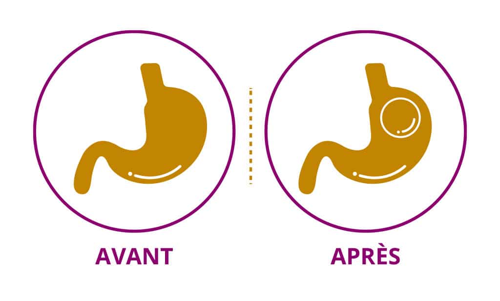 fonctionnement-ballon-gastrique